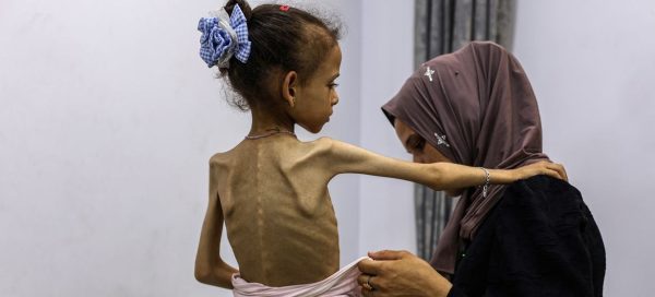 الجوع يفتك بالفلسطينيين بسبب حرب غزة